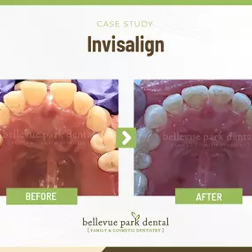 Case Study: Invisalign