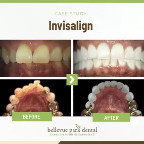 Case Study: Invisalign