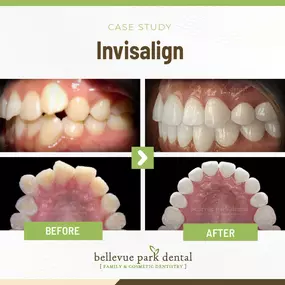 Case Study: Invisalign