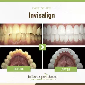 Case Study: Invisalign