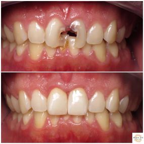 A New Smile Is Just A Few Appointments Away! A New Smile with All Porcelain Crowns can do Wonders!