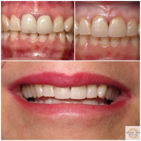 Old Crowns can easily be replace with newer All Porcelain Crowns to Rejuvenate your Smile!