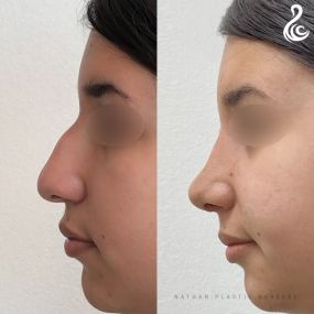 Rhinoplasty (Nose Job) Before and After Photo. Rhinoplasty performed at The Nathan Clinic in Miami, FL.