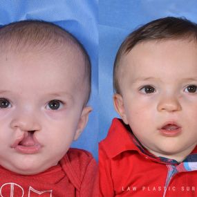 Cleft Lip Repair Before & After Photo - Surgery by Dr. Law in Dallas, TX.