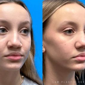 Rhinoplasty (Nose Job) Before & After Photo. Surgery performed in Dallas, TX at Law Plastic Surgery.