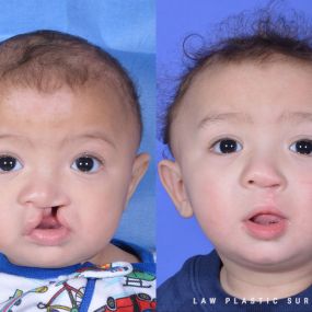 Cleft Lip Repair Before & After Photo - Surgery by Dr. Law in Dallas, TX.