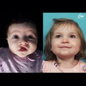 Cleft Lip Repair Before & After Photo - Surgery by Dr. Law in Dallas, TX.