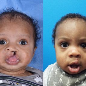 Cleft Lip Repair Before & After Photo - Surgery by Dr. Law in Dallas, TX.