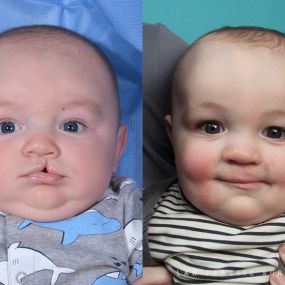 Cleft Lip Repair Before & After Photo - Surgery by Dr. Law in Dallas, TX.