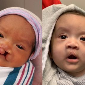 Cleft Lip Repair Before & After Photo - Surgery by Dr. Law in Dallas, TX.