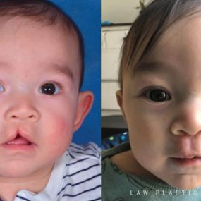 Cleft Lip Repair Before & After Photo - Surgery by Dr. Law in Dallas, TX.