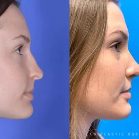 Rhinoplasty (Nose Job) Before & After Photo. Surgery performed in Dallas, TX at Law Plastic Surgery.