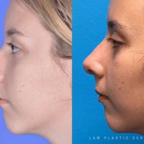 Rhinoplasty (Nose Job) Before & After Photo. Surgery performed in Dallas, TX at Law Plastic Surgery.