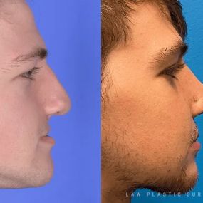 Rhinoplasty (Nose Job) Before & After Photo. Surgery performed in Dallas, TX at Law Plastic Surgery.