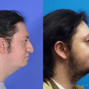 Rhinoplasty (Nose Job) Before & After Photo. Surgery performed in Dallas, TX at Law Plastic Surgery.