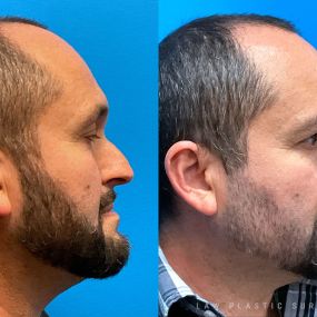 Rhinoplasty (Nose Job) Before & After Photo. Surgery performed in Dallas, TX at Law Plastic Surgery.