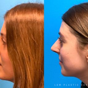 Rhinoplasty (Nose Job) Before & After Photo. Surgery performed in Dallas, TX at Law Plastic Surgery.