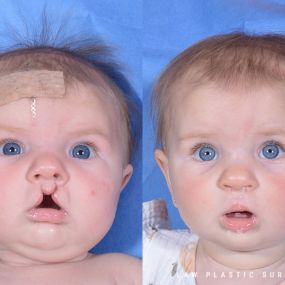 Cleft Lip Repair Before & After Photo - Surgery by Dr. Law in Dallas, TX.