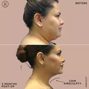 Chin AirSculpt Before and After