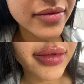 Bild von Skin Tightening, Botox and Lip Fillers by Skinsation LA