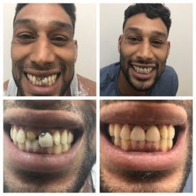 Two front Crowns_before and after - My Dentist For Life Of Plantation