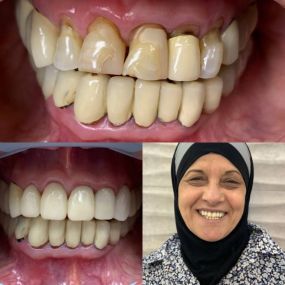 Ceramic Crowns_Before and After