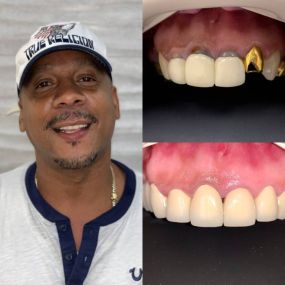 Smile make over with crowns-before and after - My Dentist For Life Of Plantation