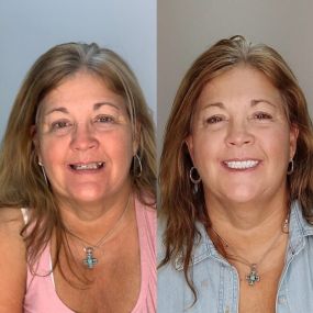 Dentures before and after