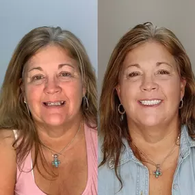 Dentures before and after