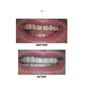 Before and after patient underwent dental restoration with Dr. Jack Bodie, DDS