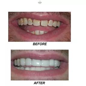 Before and after patient underwent dental restoration with Dr. Jack Bodie, DDS