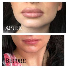 Why lips?
Your smile is one of the first things people notice when they look at you. Fuller lips are a sign of youth. This natural beauty only needed a little enhancement.
Call 303-668-6468
Not sure what it will look like? Lips don’t have to be overdone. Choose to do the process gradually- in stages and should be done this way in everyone. Age-appropriate lips are always most attractive.