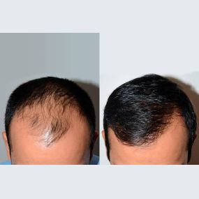 Bild von Foundation for Hair Restoration