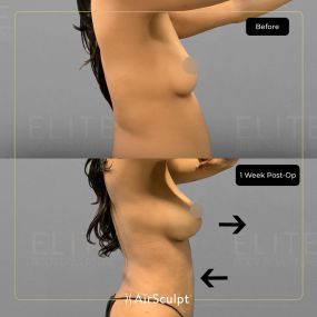 Bild von AirSculpt - Beverly Hills