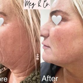 Before and after Genius Radio Frequency microneedling and LaseMD Ultra. Face and neck lifted, wrinkles significantly diminished and skin tone and texture evened out.