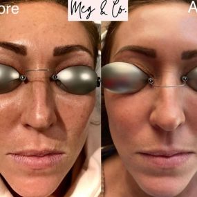 Before and After Two LaseMD Ultra Treatments
