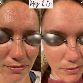 Before and After One LaseMD Ultra Treatment