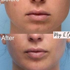 Jawline slimming with botox injections
