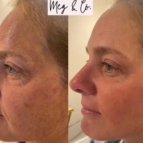 Before and after Total Skin Solutio (Genius Radio Frequency microneedling and LaseMD Ultra)