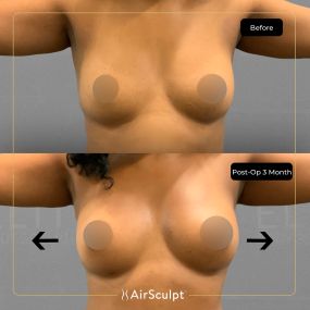 Check out the dramatic, yet seamless transformation patients achieve AirSculpt. This patented technology plucks fat cells one by one with robotic precision, all done through a minuscule entryway that leaves at most a freckle-sized mark. For patients seeking more volume in certain areas, we can also transfer fat to naturally enhance the breasts, buttocks, hips, or hands.
