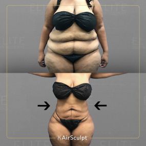 Check out the dramatic, yet seamless transformation patients achieve AirSculpt. This patented technology plucks fat cells one by one with robotic precision, all done through a minuscule entryway that leaves at most a freckle-sized mark. For patients seeking more volume in certain areas, we can also transfer fat to naturally enhance the breasts, buttocks, hips, or hands.