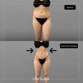 Check out the dramatic, yet seamless transformation patients achieve AirSculpt. This patented technology plucks fat cells one by one with robotic precision, all done through a minuscule entryway that leaves at most a freckle-sized mark. For patients seeking more volume in certain areas, we can also transfer fat to naturally enhance the breasts, buttocks, hips, or hands.