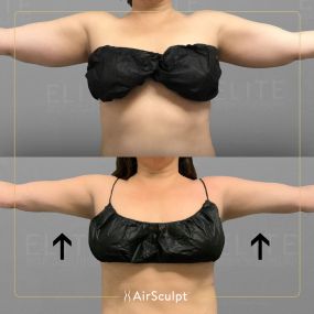 Check out the dramatic, yet seamless transformation patients achieve AirSculpt. This patented technology plucks fat cells one by one with robotic precision, all done through a minuscule entryway that leaves at most a freckle-sized mark. For patients seeking more volume in certain areas, we can also transfer fat to naturally enhance the breasts, buttocks, hips, or hands.