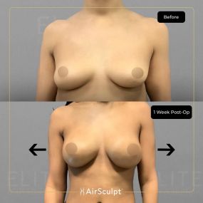 Check out the dramatic, yet seamless transformation patients achieve AirSculpt. This patented technology plucks fat cells one by one with robotic precision, all done through a minuscule entryway that leaves at most a freckle-sized mark. For patients seeking more volume in certain areas, we can also transfer fat to naturally enhance the breasts, buttocks, hips, or hands.