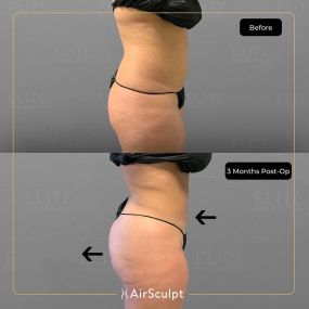 Check out the dramatic, yet seamless transformation patients achieve AirSculpt. This patented technology plucks fat cells one by one with robotic precision, all done through a minuscule entryway that leaves at most a freckle-sized mark. For patients seeking more volume in certain areas, we can also transfer fat to naturally enhance the breasts, buttocks, hips, or hands.