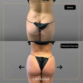 Check out the dramatic, yet seamless transformation patients achieve AirSculpt. This patented technology plucks fat cells one by one with robotic precision, all done through a minuscule entryway that leaves at most a freckle-sized mark. For patients seeking more volume in certain areas, we can also transfer fat to naturally enhance the breasts, buttocks, hips, or hands.