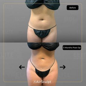 Check out the dramatic, yet seamless transformation patients achieve AirSculpt. This patented technology plucks fat cells one by one with robotic precision, all done through a minuscule entryway that leaves at most a freckle-sized mark. For patients seeking more volume in certain areas, we can also transfer fat to naturally enhance the breasts, buttocks, hips, or hands.