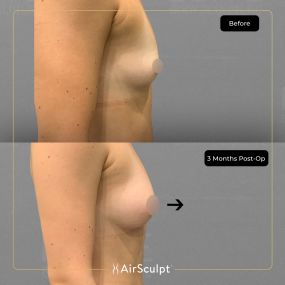 Check out the dramatic, yet seamless transformation patients achieve AirSculpt. This patented technology plucks fat cells one by one with robotic precision, all done through a minuscule entryway that leaves at most a freckle-sized mark. For patients seeking more volume in certain areas, we can also transfer fat to naturally enhance the breasts, buttocks, hips, or hands.