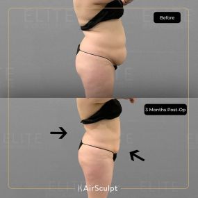 Check out the dramatic, yet seamless transformation patients achieve AirSculpt. This patented technology plucks fat cells one by one with robotic precision, all done through a minuscule entryway that leaves at most a freckle-sized mark. For patients seeking more volume in certain areas, we can also transfer fat to naturally enhance the breasts, buttocks, hips, or hands.