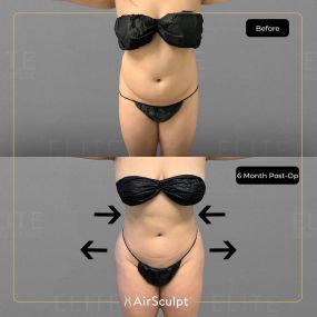 Check out the dramatic, yet seamless transformation patients achieve AirSculpt. This patented technology plucks fat cells one by one with robotic precision, all done through a minuscule entryway that leaves at most a freckle-sized mark. For patients seeking more volume in certain areas, we can also transfer fat to naturally enhance the breasts, buttocks, hips, or hands.